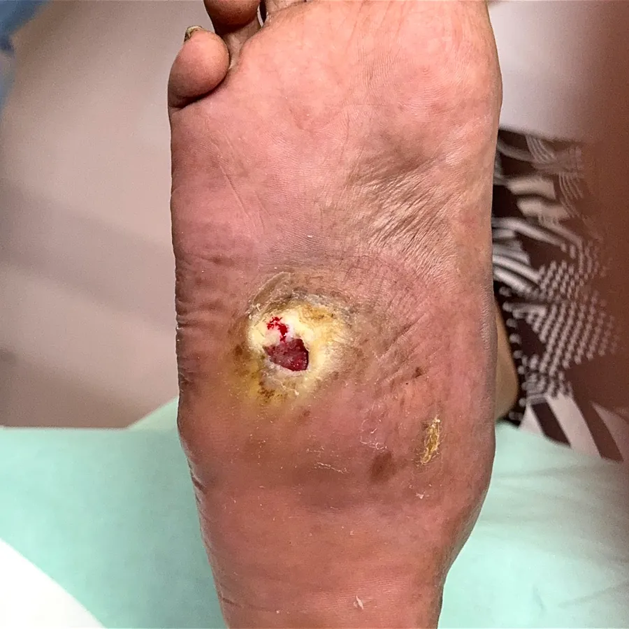 Clinical photograph of a diabetic plantar wound at visit 5, HKL-31