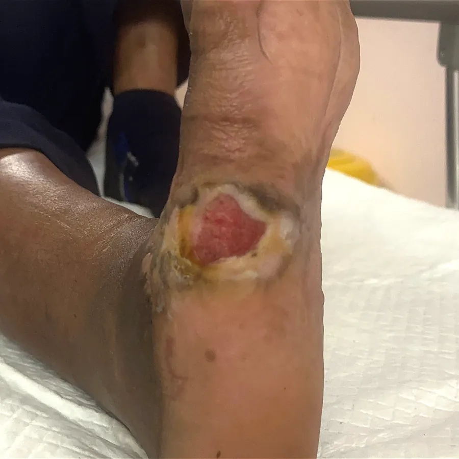 Clinical photograph of a diabetic plantar wound at visit 1, HKL-32