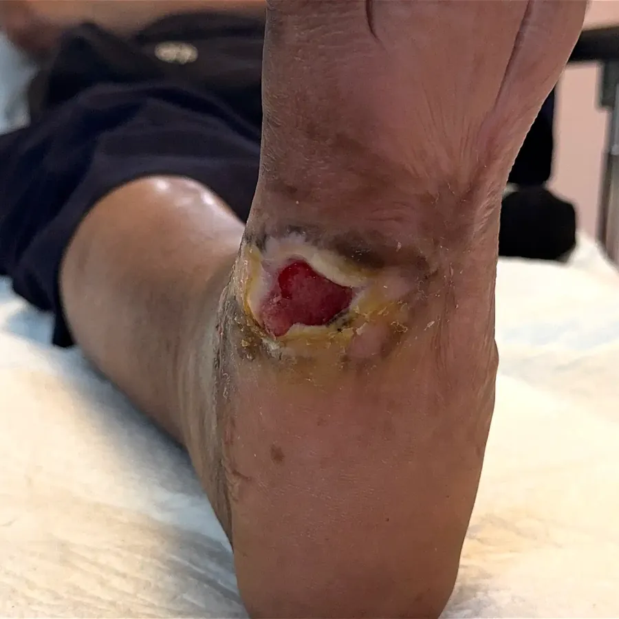 Clinical photograph of a diabetic plantar wound at visit 2, HKL-32