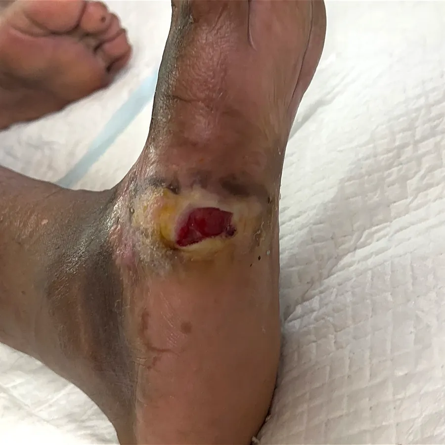Clinical photograph of a diabetic plantar wound at visit 3, HKL-32