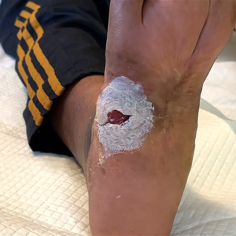 Clinical photograph of a diabetic plantar wound at visit 4, HKL-32