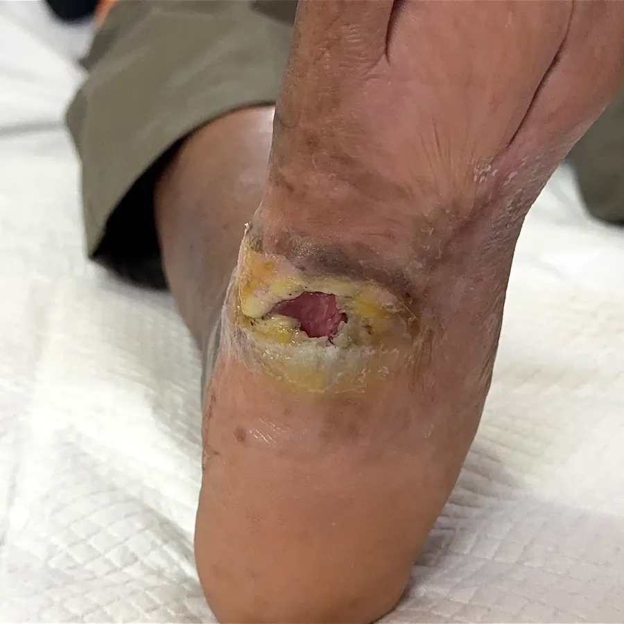 Clinical photograph of a diabetic plantar wound at visit 5, HKL-32