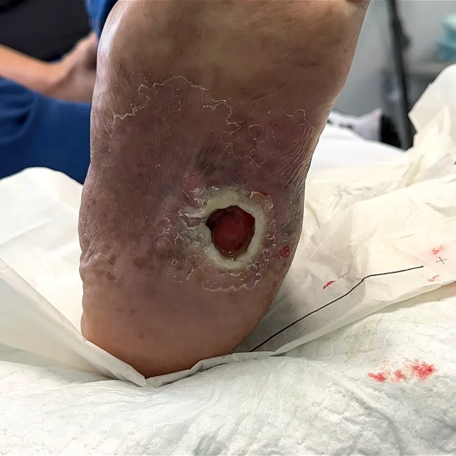 Clinical photograph of a diabetic plantar wound at visit 1, HKL-33
