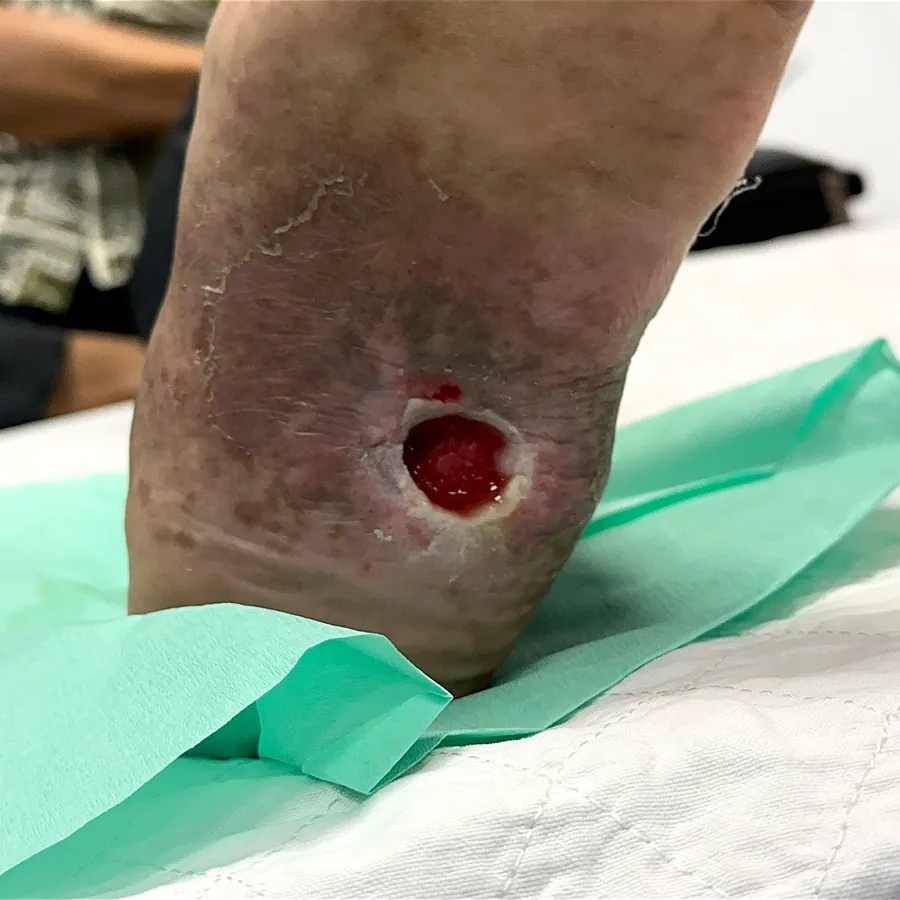 Clinical photograph of a diabetic plantar wound at visit 2, HKL-33
