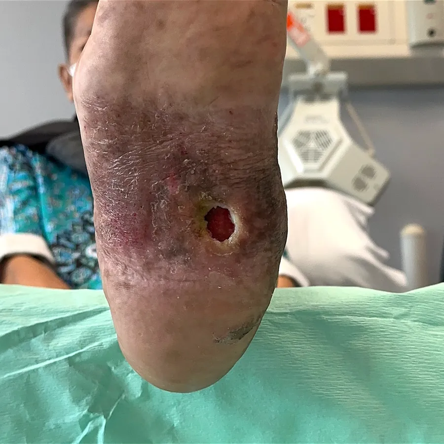 Clinical photograph of a diabetic plantar wound at visit 3, HKL-33