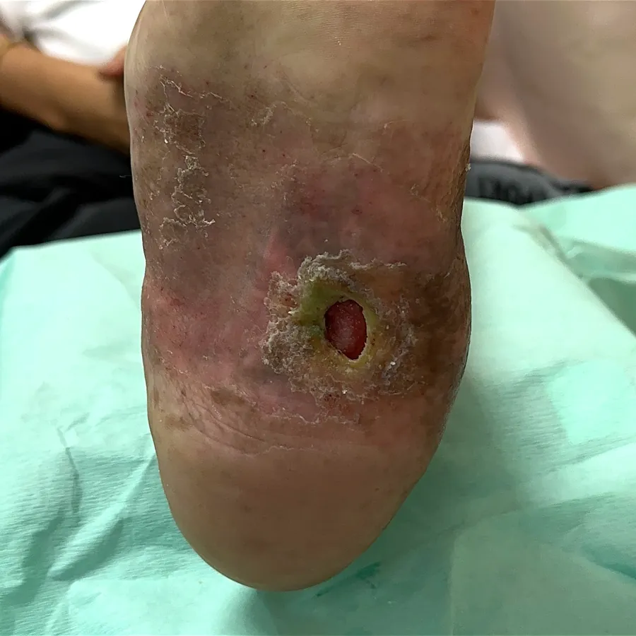 Clinical photograph of a diabetic plantar wound at visit 4, HKL-33
