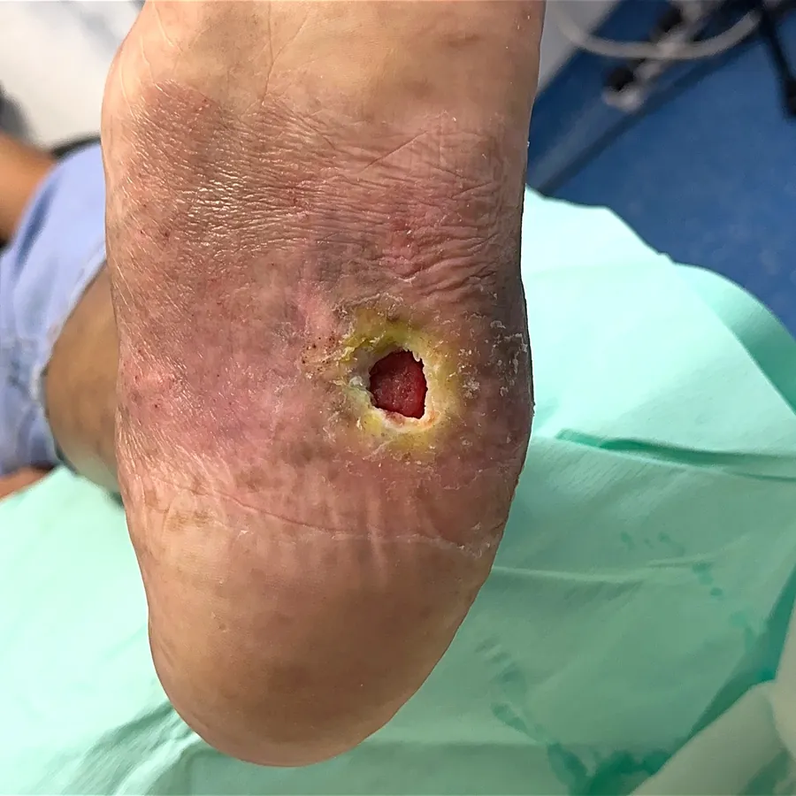 Clinical photograph of a diabetic plantar wound at visit 5, HKL-33