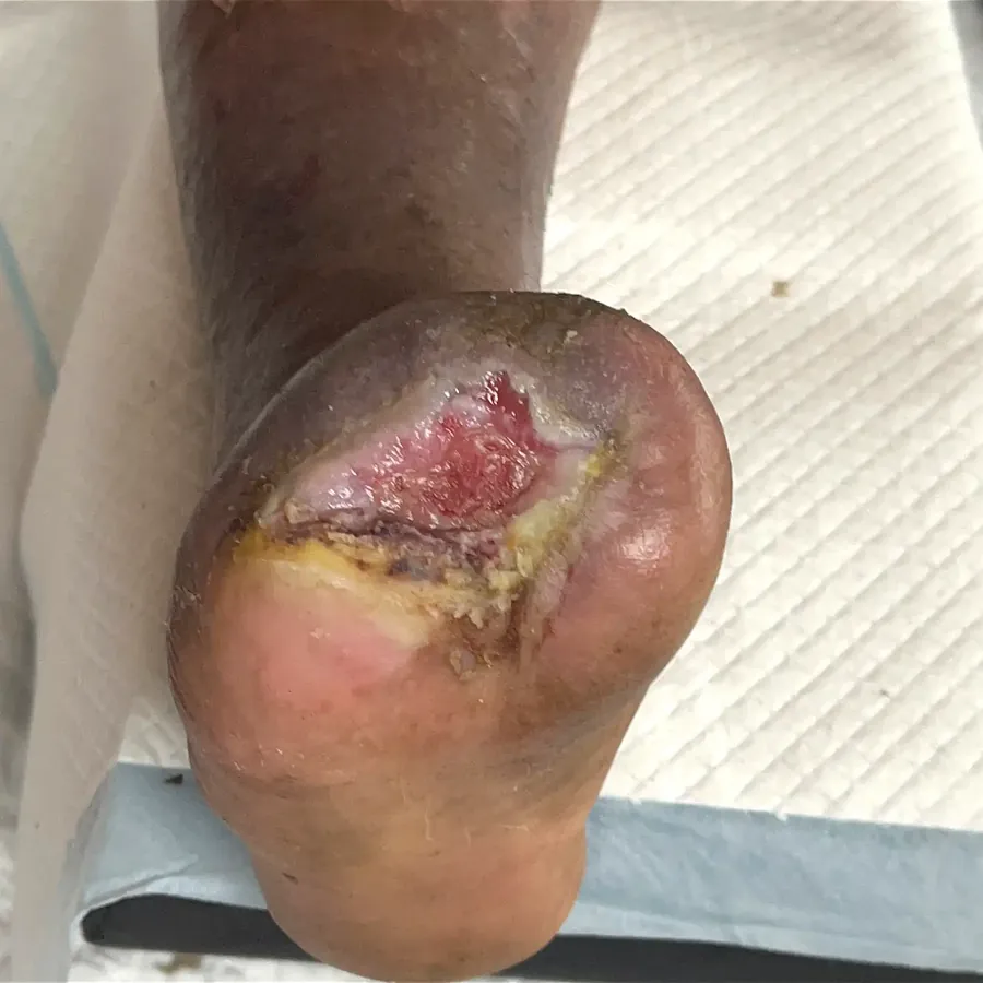 Clinical photograph of a diabetic plantar wound at visit 1, HKL-34