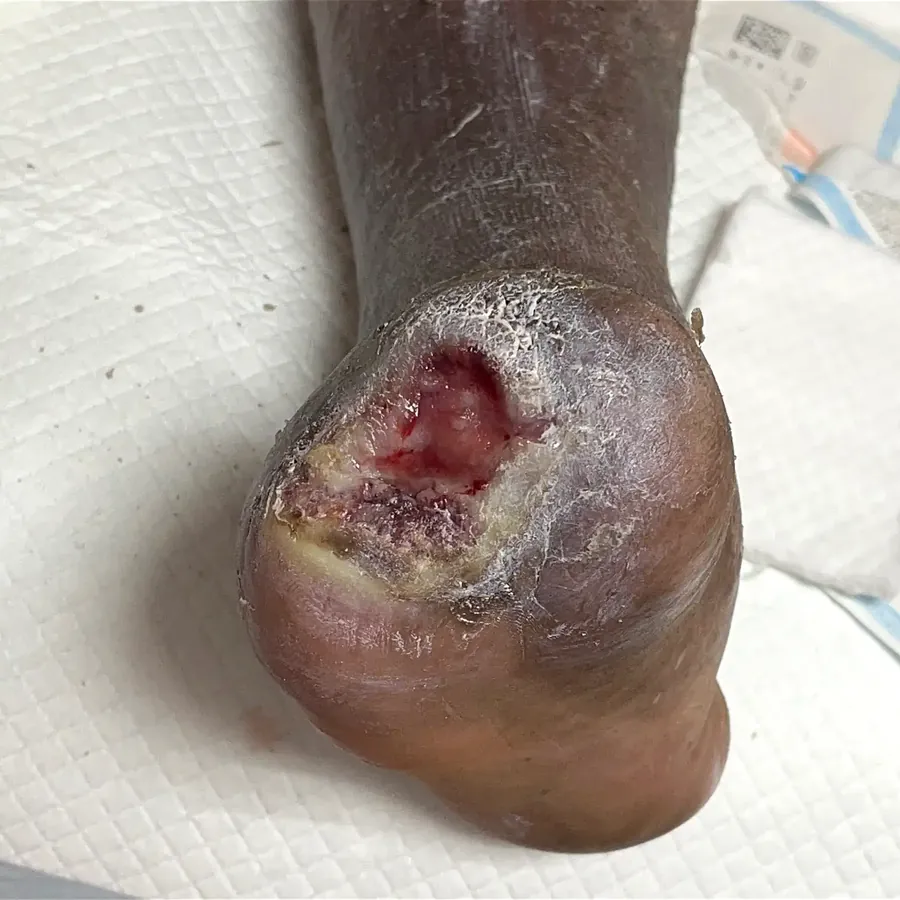 Clinical photograph of a diabetic plantar wound at visit 2, HKL-34