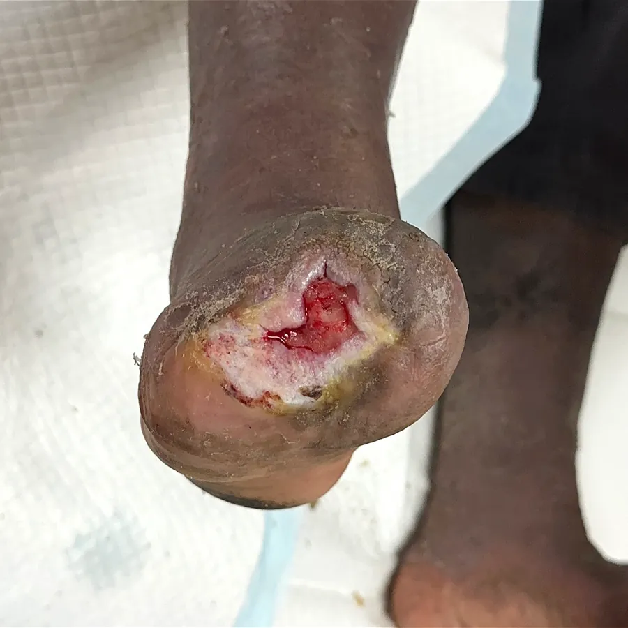 Clinical photograph of a diabetic plantar wound at visit 3, HKL-34