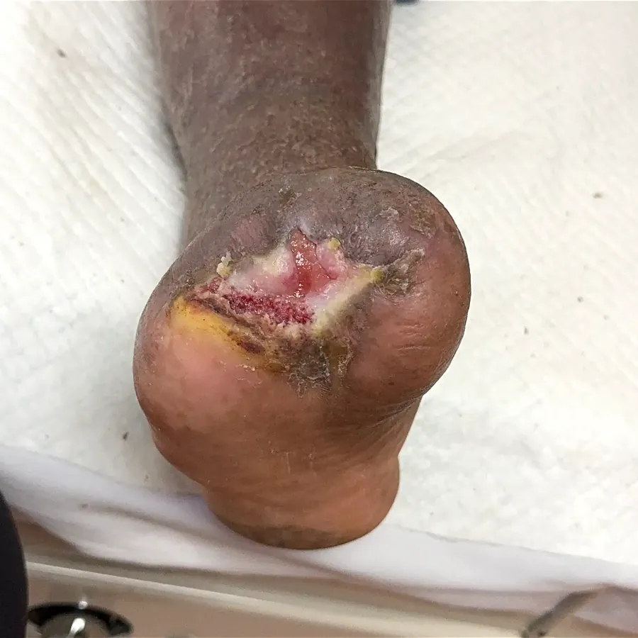 Clinical photograph of a diabetic plantar wound at visit 4, HKL-34