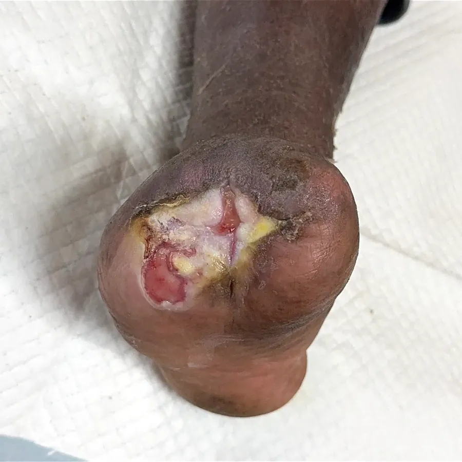 Clinical photograph of a diabetic plantar wound at visit 5, HKL-34