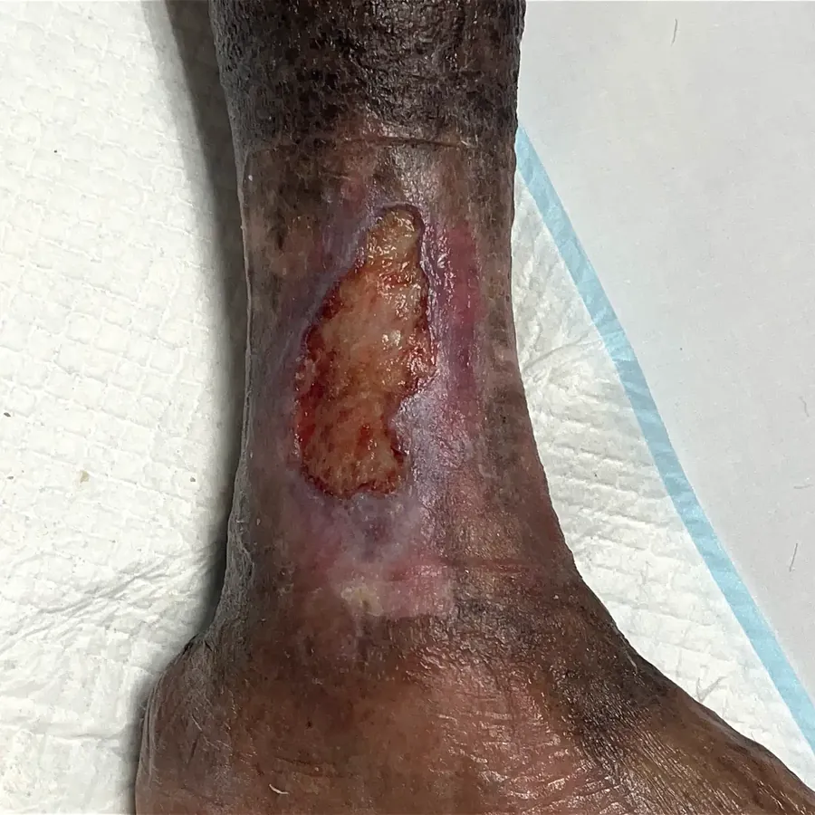 Clinical photograph of a lymphovascular leg wound at visit 1, HKL-35