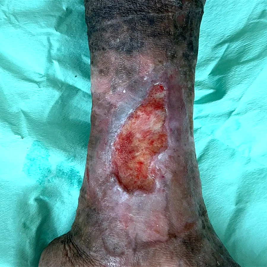 Clinical photograph of a lymphovascular leg wound at visit 2, HKL-35