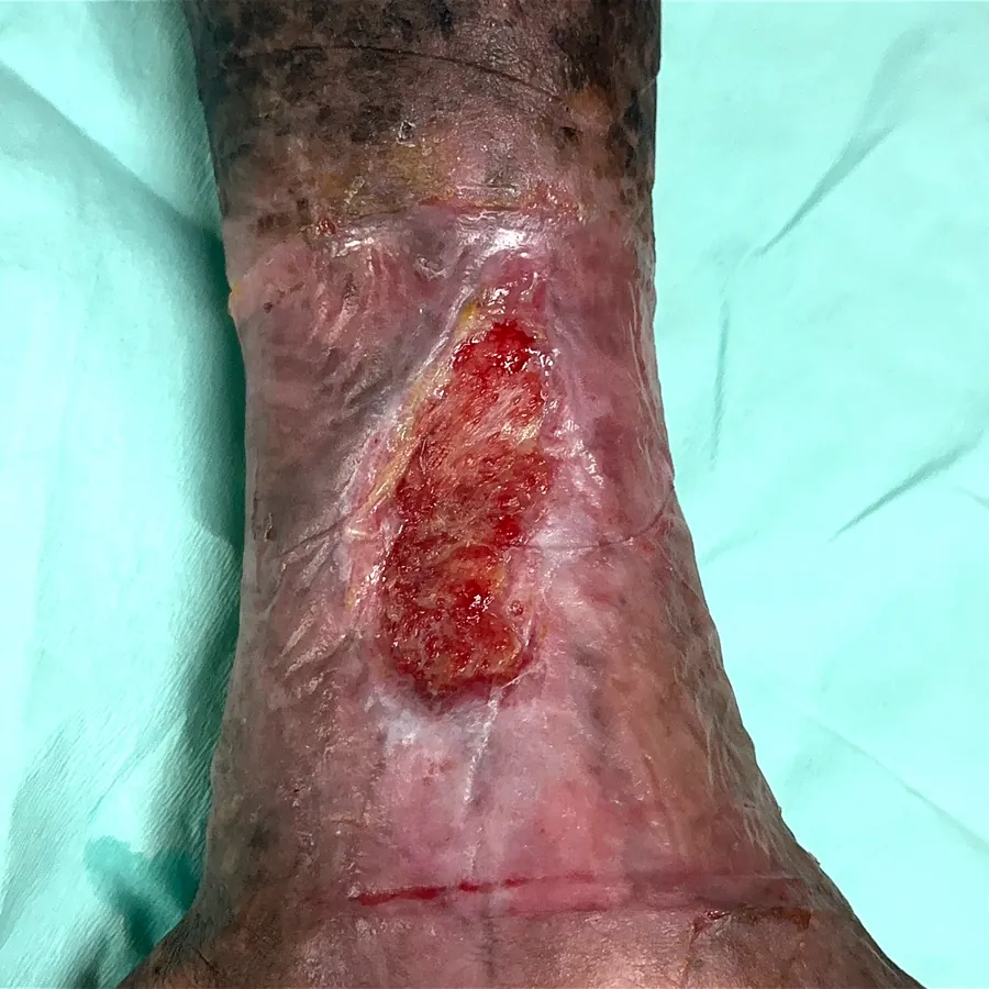 Clinical photograph of a lymphovascular leg wound at visit 3, HKL-35