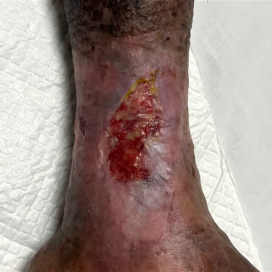 Clinical photograph of a lymphovascular leg wound at visit 4, HKL-35