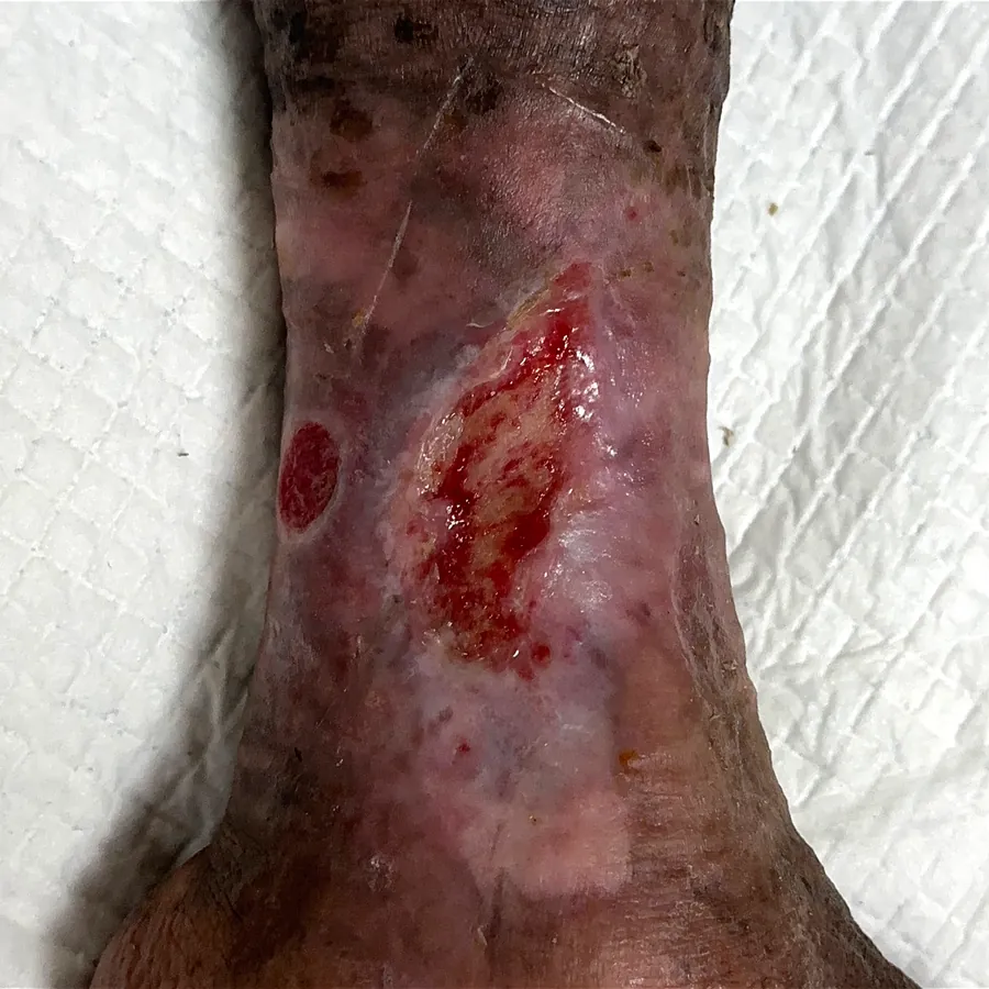 Clinical photograph of a lymphovascular leg wound at visit 5, HKL-35