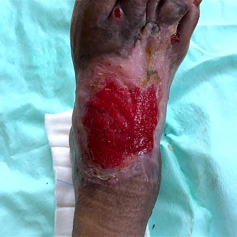 Clinical photograph of a diabetic foot wound at visit 1, HKL-36