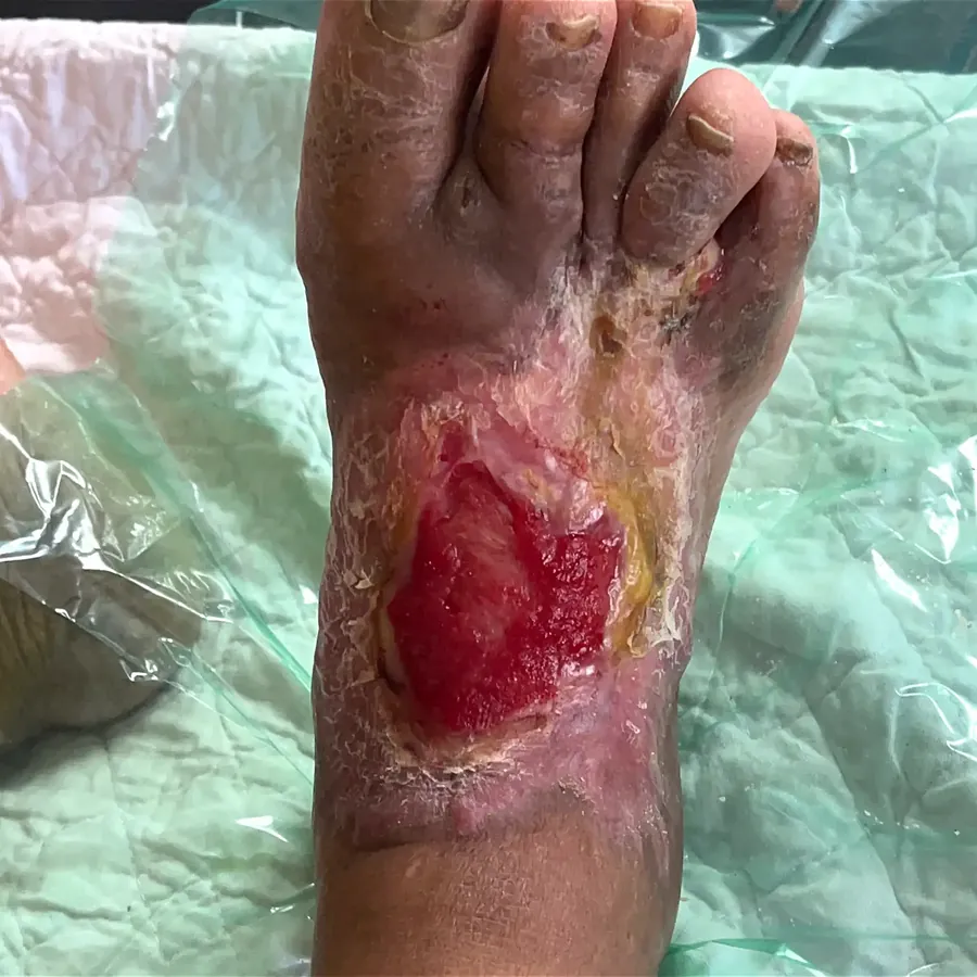 Clinical photograph of a diabetic foot wound at visit 2, HKL-36