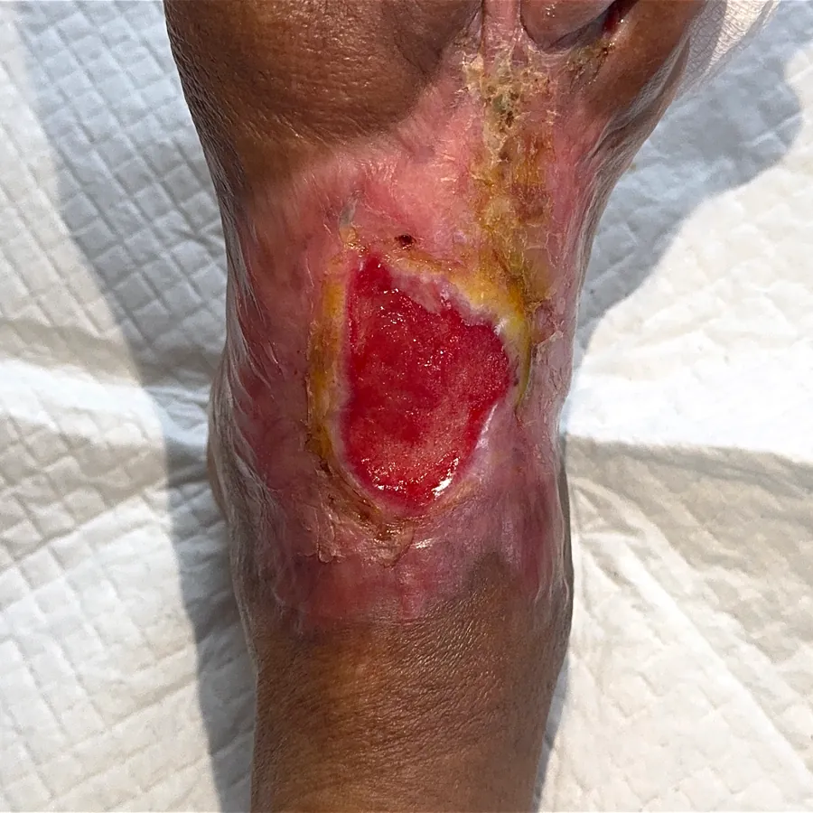 Clinical photograph of a diabetic foot wound at visit 3, HKL-36