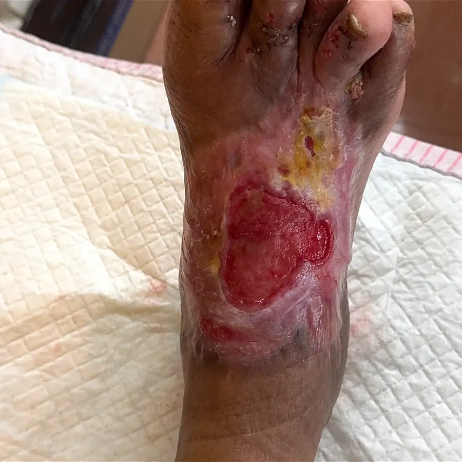 Clinical photograph of a diabetic foot wound at visit 4, HKL-36