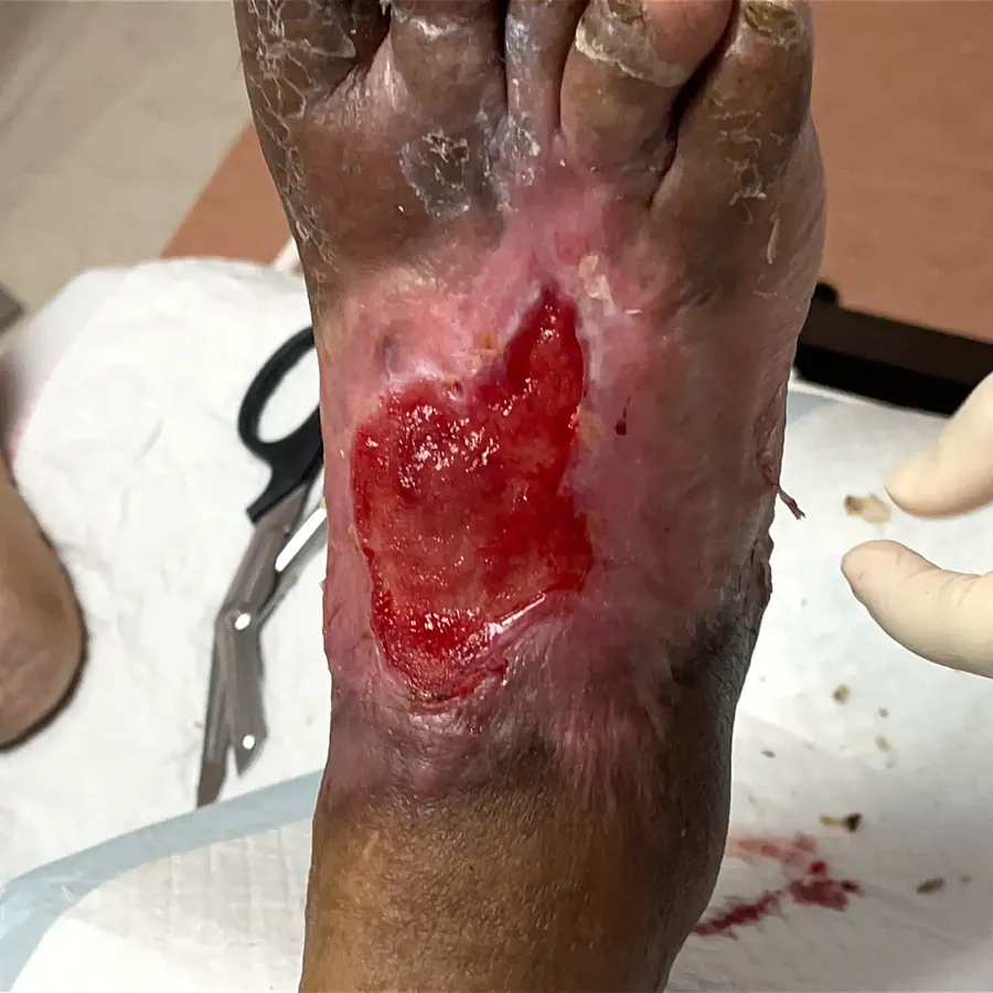 Clinical photograph of a diabetic foot wound at visit 5, HKL-36