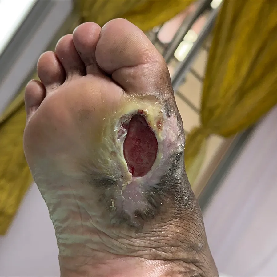 Clinical photograph of a diabetic plantar wound at visit 1, HKL-37
