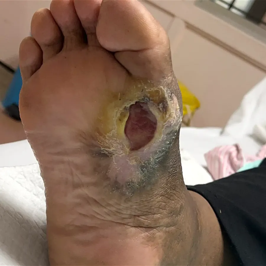 Clinical photograph of a diabetic plantar wound at visit 2, HKL-37