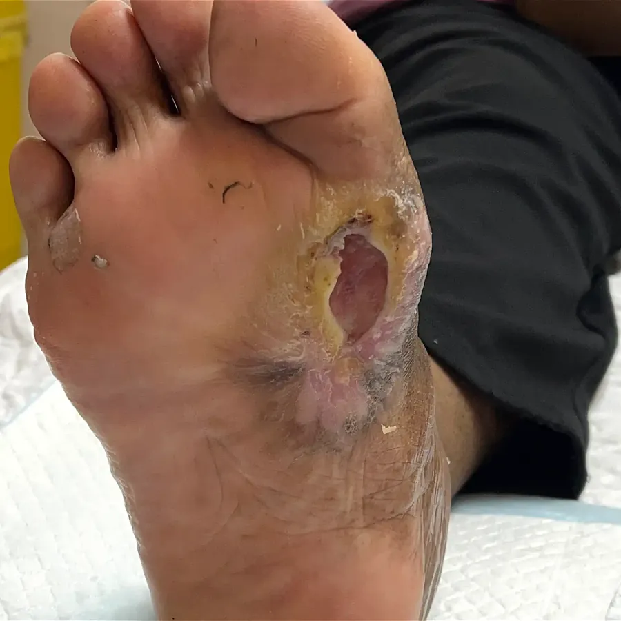 Clinical photograph of a diabetic plantar wound at visit 3, HKL-37