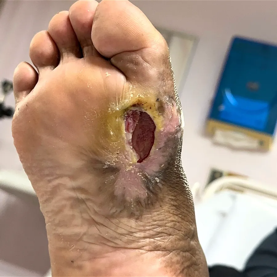 Clinical photograph of a diabetic plantar wound at visit 4, HKL-37