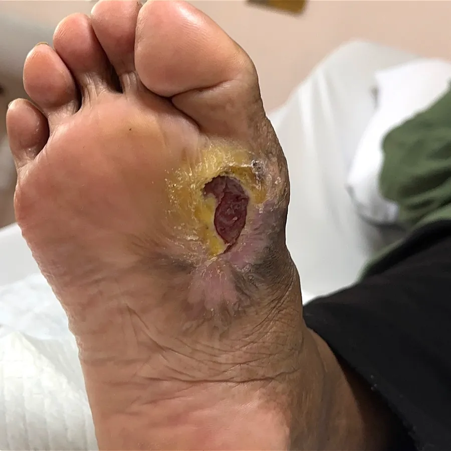 Clinical photograph of a diabetic plantar wound at visit 5, HKL-37