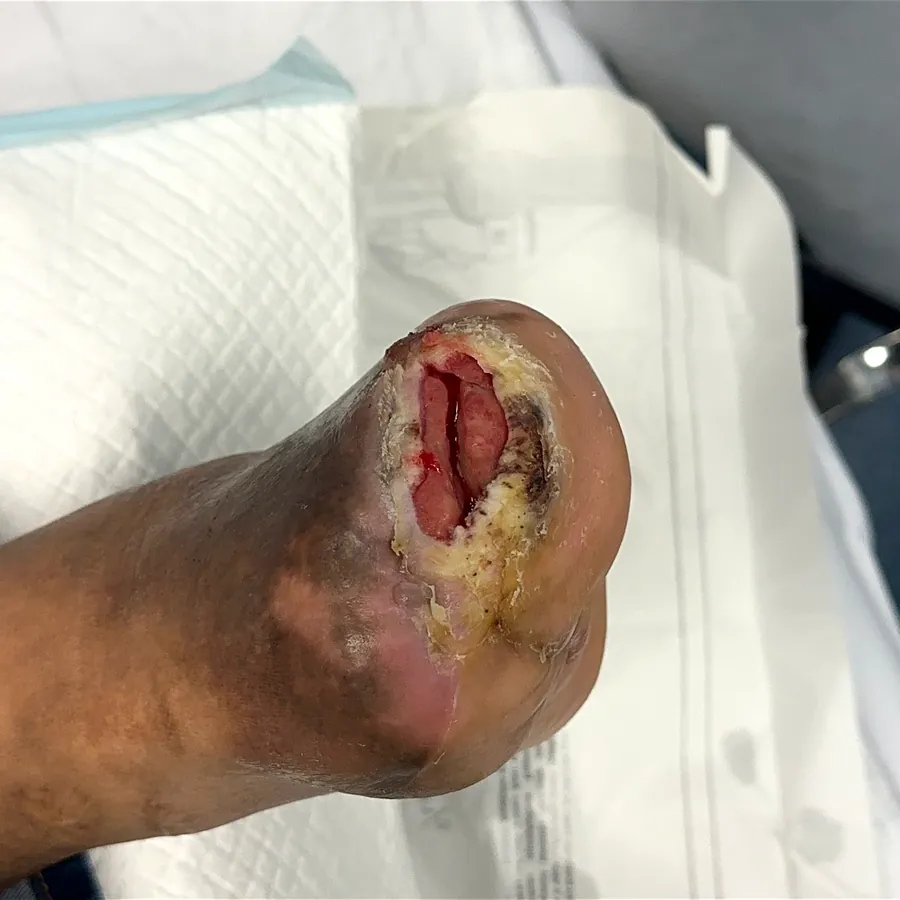Clinical photograph of a diabetic foot wound at visit 1, HKL-38