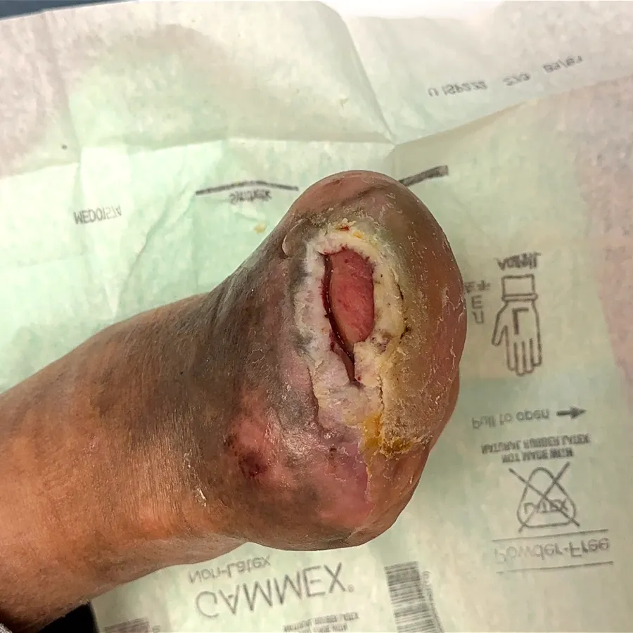 Clinical photograph of a diabetic foot wound at visit 2, HKL-38