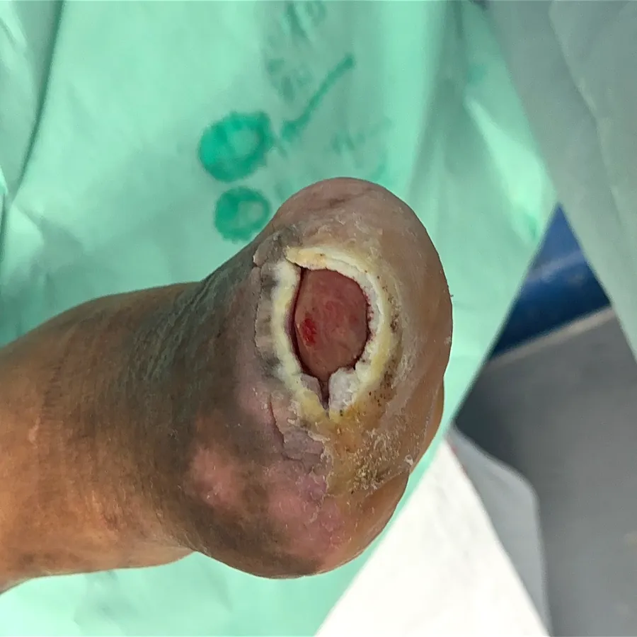 Clinical photograph of a diabetic foot wound at visit 3, HKL-38