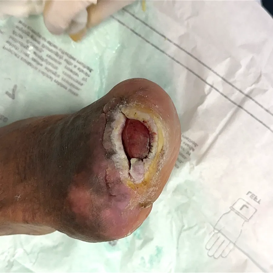 Clinical photograph of a diabetic foot wound at visit 4, HKL-38