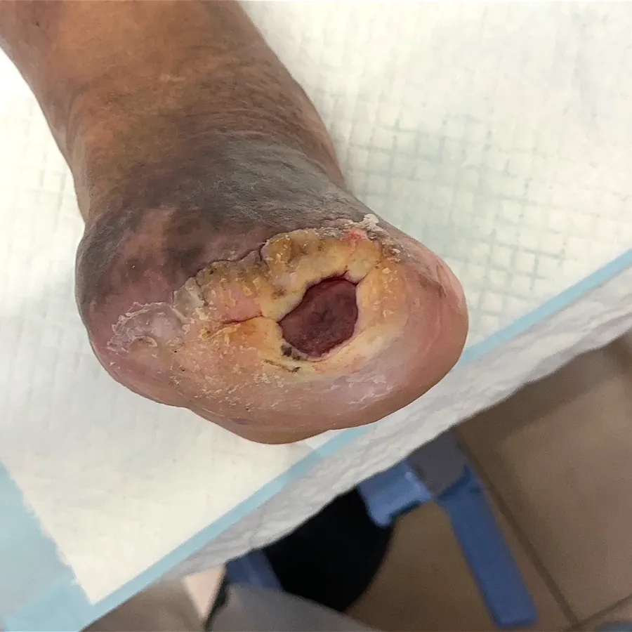 Clinical photograph of a diabetic foot wound at visit 5, HKL-38