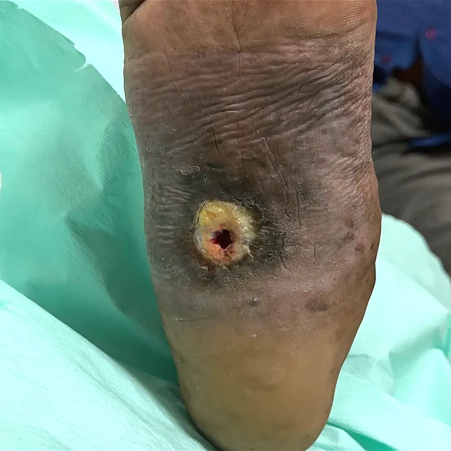Clinical photograph of a diabetic plantar wound at visit 1, HKL-39