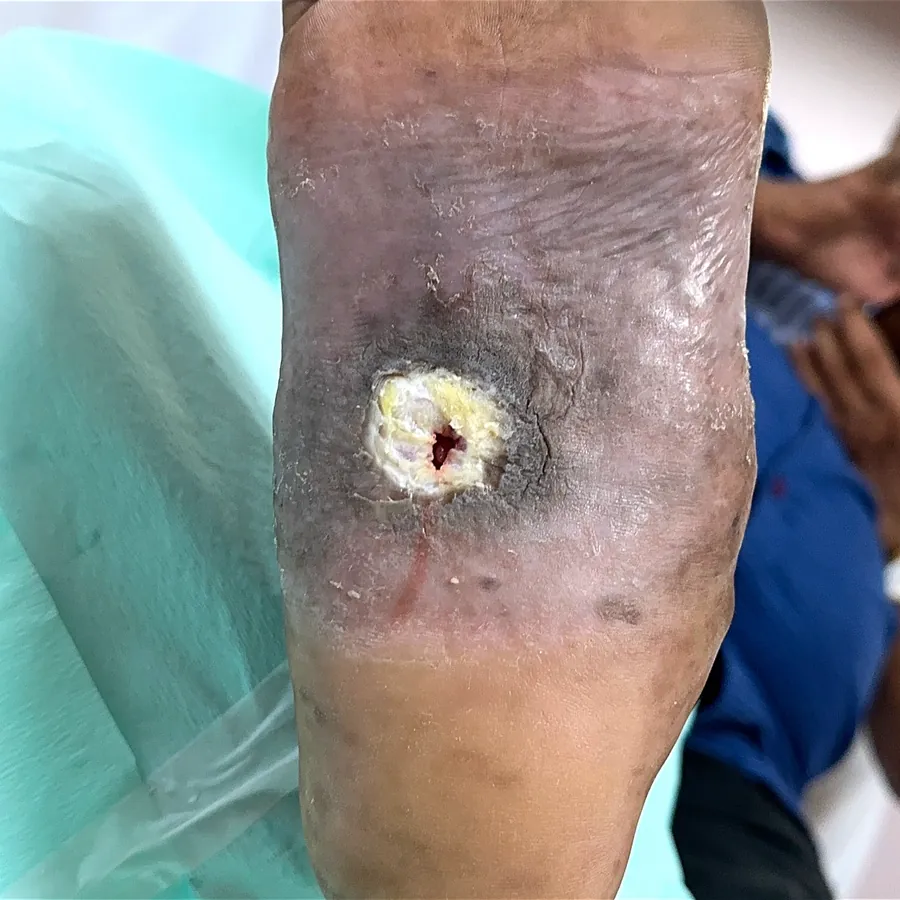 Clinical photograph of a diabetic plantar wound at visit 2, HKL-39