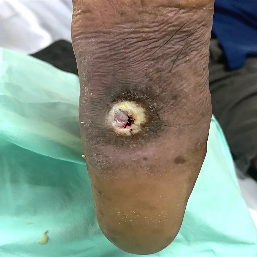 Clinical photograph of a diabetic plantar wound at visit 3, HKL-39