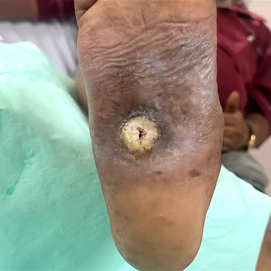 Clinical photograph of a diabetic plantar wound at visit 4, HKL-39