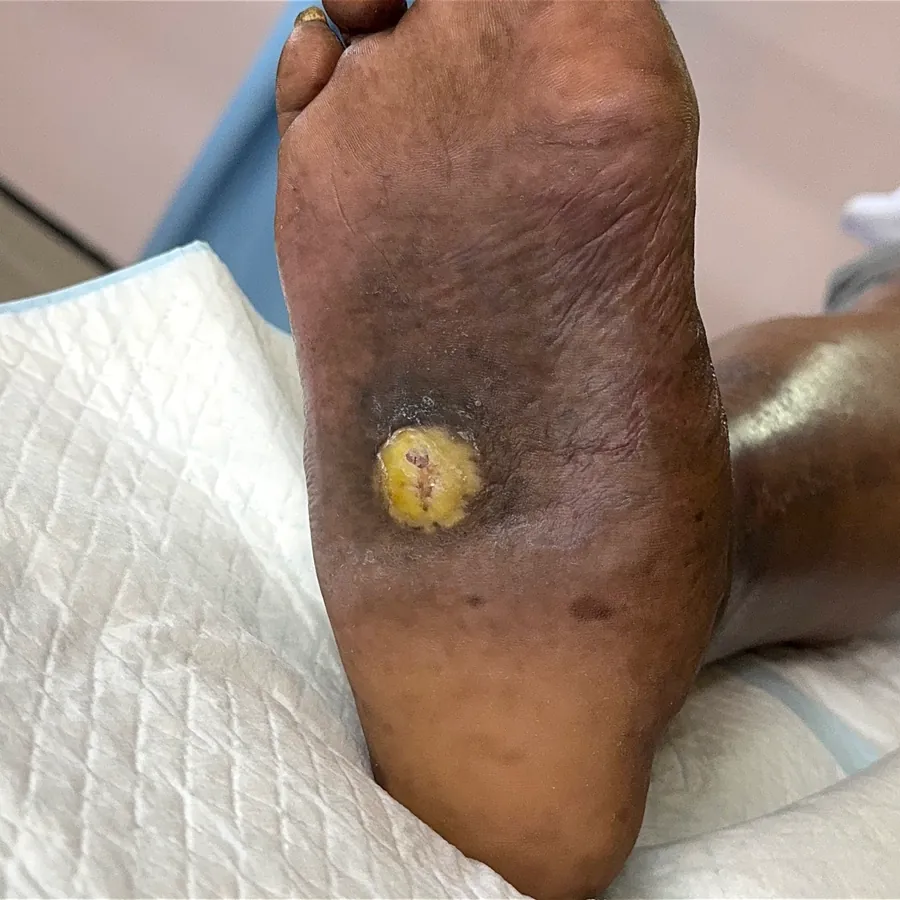 Clinical photograph of a diabetic plantar wound at visit 5, HKL-39