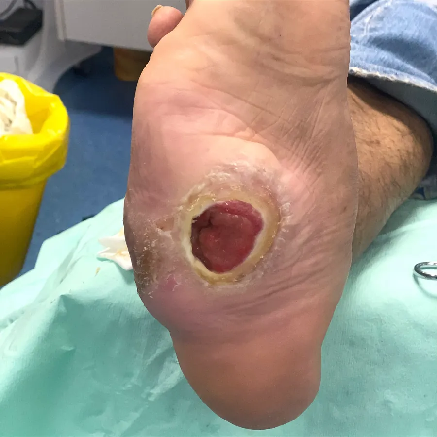 Clinical photograph of a diabetic plantar wound at visit 1, HKL-40