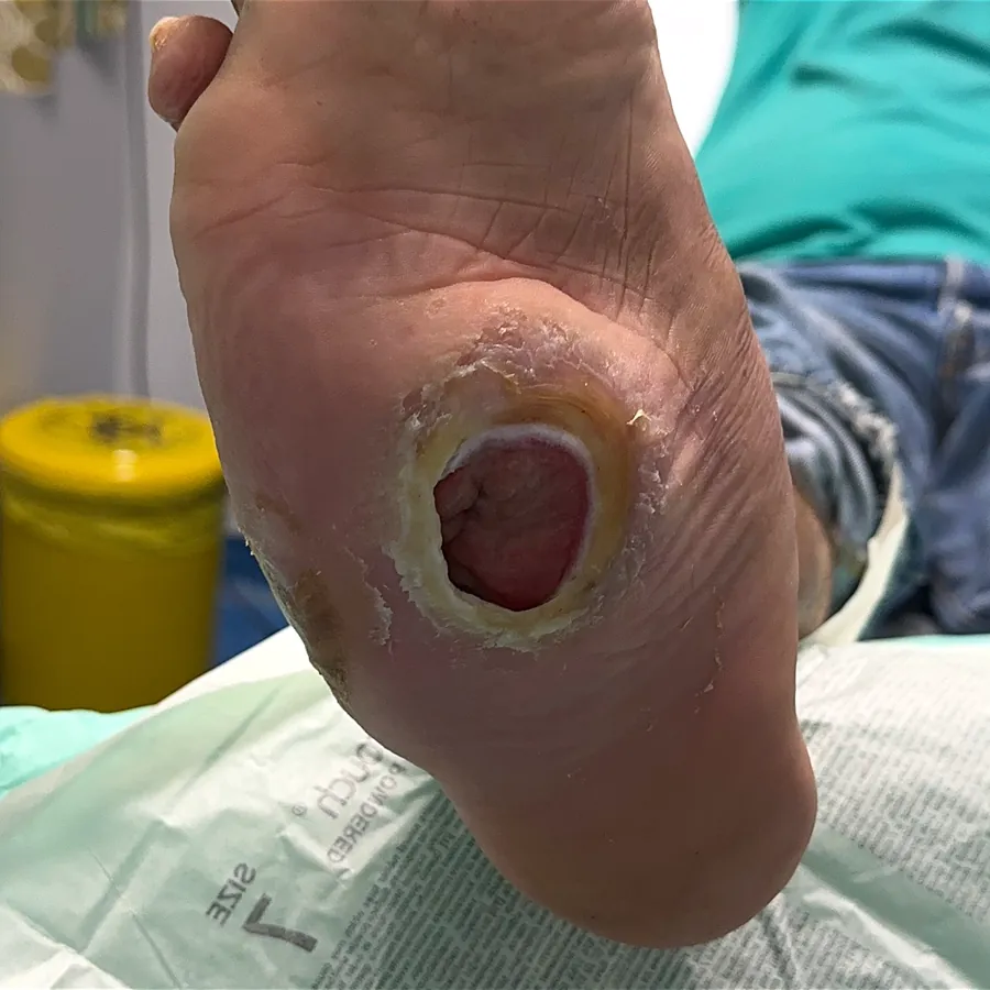 Clinical photograph of a diabetic plantar wound at visit 2, HKL-40