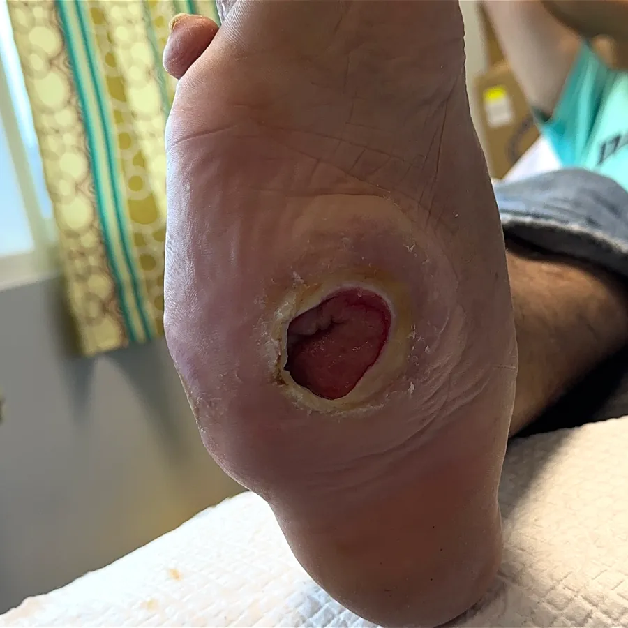 Clinical photograph of a diabetic plantar wound at visit 3, HKL-40