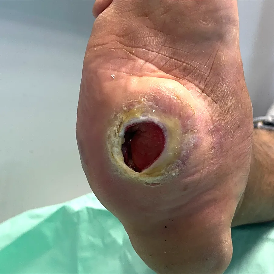 Clinical photograph of a diabetic plantar wound at visit 4, HKL-40