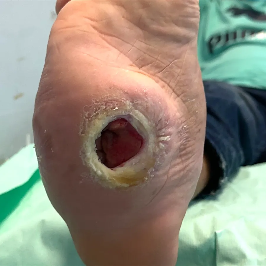 Clinical photograph of a diabetic plantar wound at visit 5, HKL-40