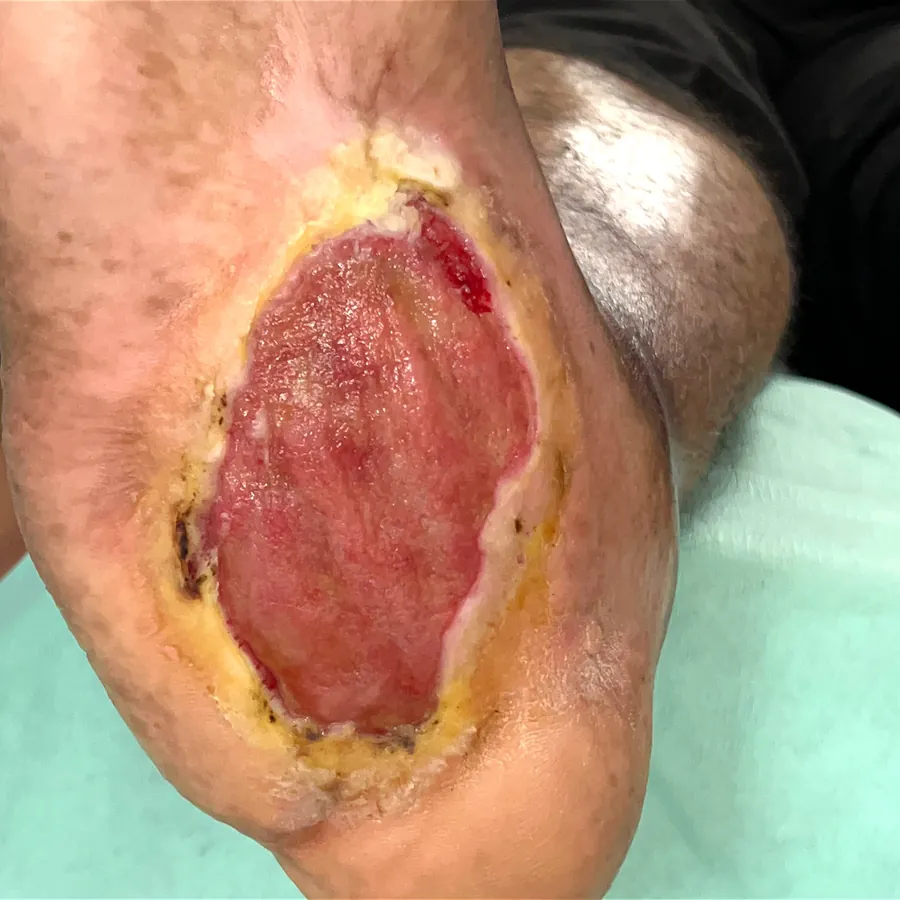 Clinical photograph of a diabetic plantar wound at visit 1, HKL-41
