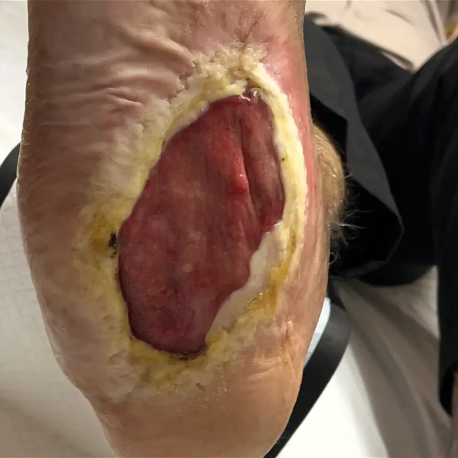 Clinical photograph of a diabetic plantar wound at visit 2, HKL-41