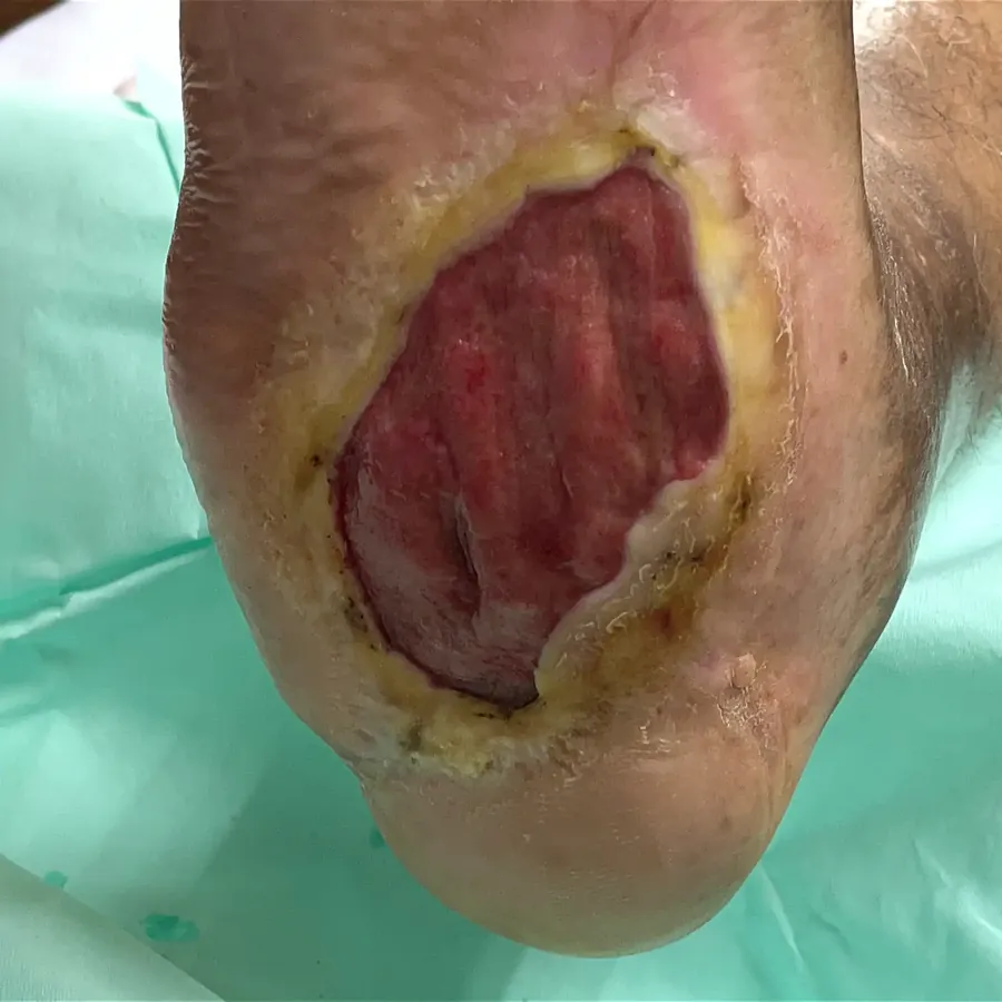 Clinical photograph of a diabetic plantar wound at visit 3, HKL-41
