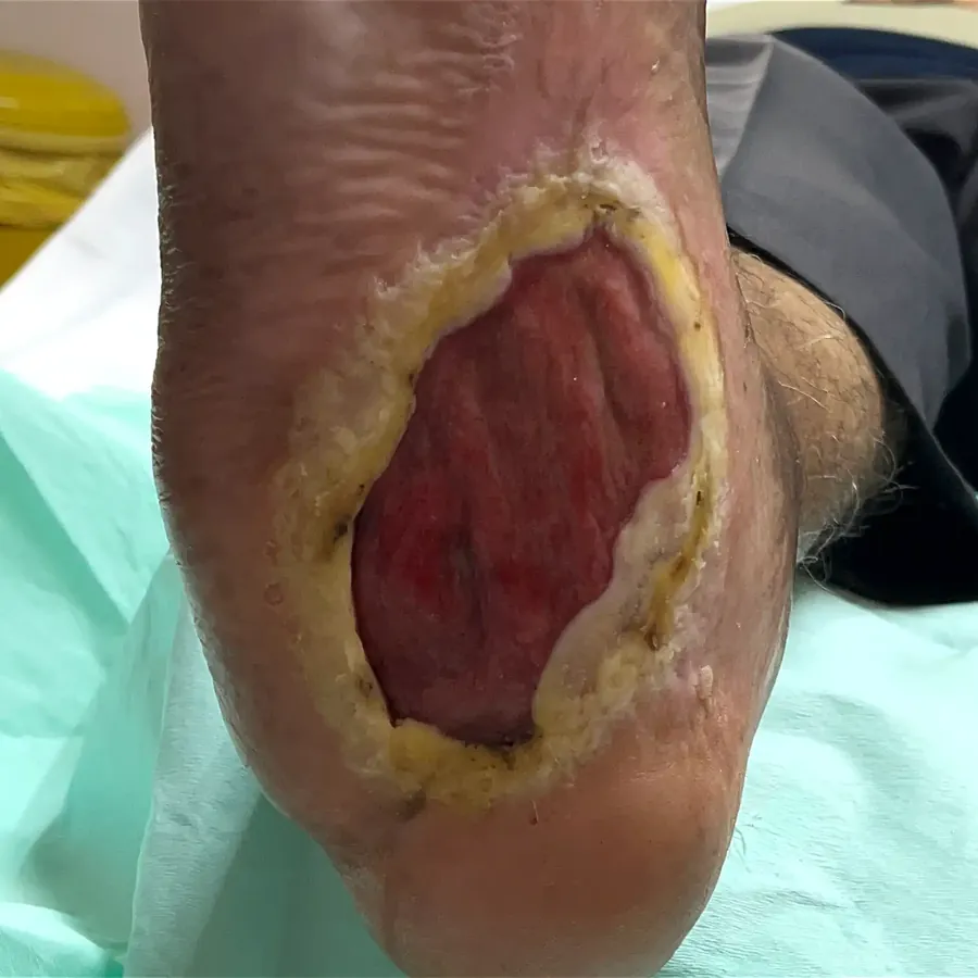 Clinical photograph of a diabetic plantar wound at visit 4, HKL-41